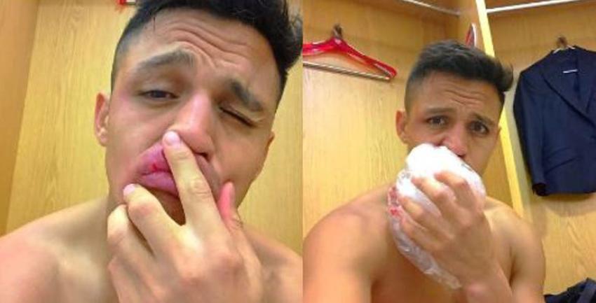 [FOTO] Exrugbista inglés se ríe de herida de Alexis Sánchez sufrida en duelo con Leicester