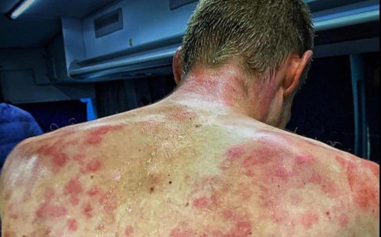 [FOTOS] Las lesiones que dejó una tormenta de granizos en los ciclistas de un torneo en Francia